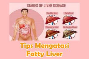 Tips Mengatasi Fatty Liver